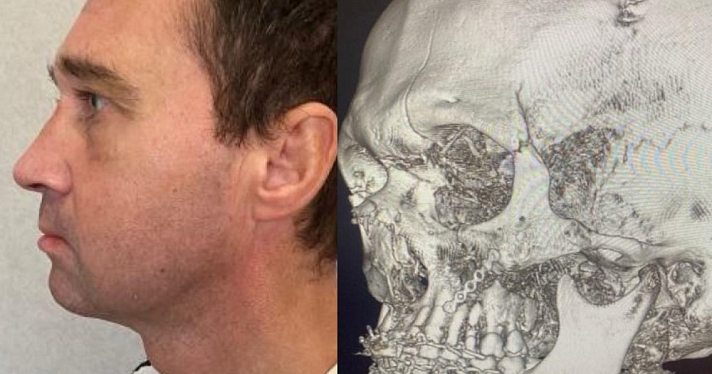 Ярославские хирурги восстановили лицо мужчине, упавшему с велосипеда