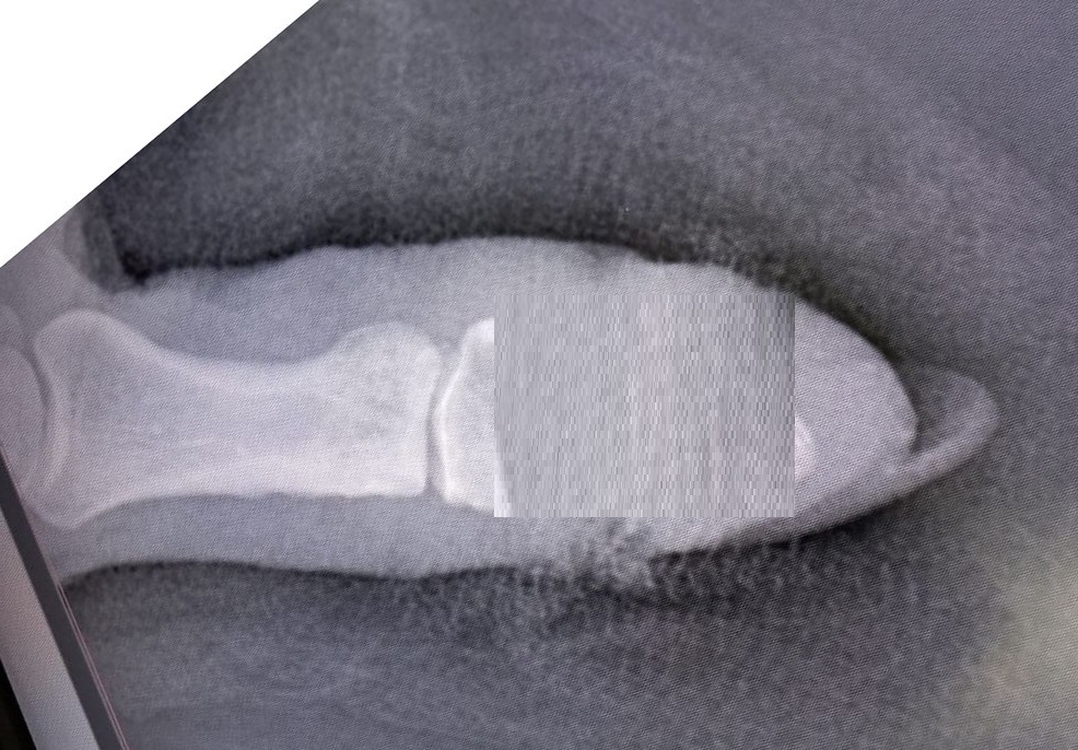 В Ярославле дачницы массово повреждают пальцы электросекаторами