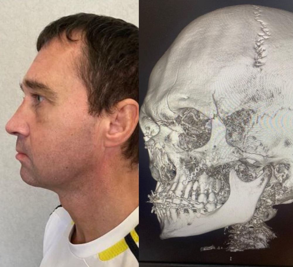 Ярославские хирурги восстановили лицо мужчине, упавшему с велосипеда