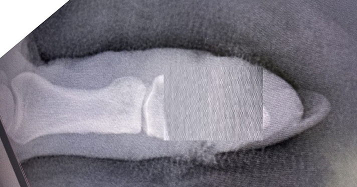 В Ярославле дачницы массово повреждают пальцы электросекаторами