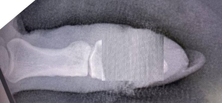 В Ярославле дачницы массово повреждают пальцы электросекаторами