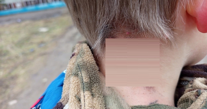 Опасные игры: в Ярославской области подростки зажгли петарду и бросили её под одежду сверстнику