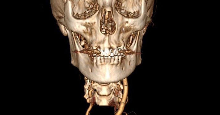 Пришлось частично вскрыть грудную клетку: в Ярославле пациентку спасли от инсульта