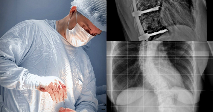 «Позвоночник напоминал букву S»: ярославские нейрохирурги провели сложнейшую операцию