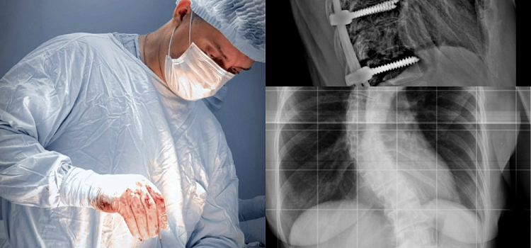 «Позвоночник напоминал букву S»: ярославские нейрохирурги провели сложнейшую операцию